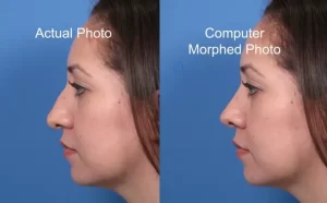 Side-by-side comparison of an actual photo and a computer-morphed photo of the same person from a side profile view against a blue background.