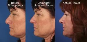 Three side-by-side images show a woman's profile. From left to right: before rhinoplasty, a computer-imaged prediction, and the actual post-surgery result.