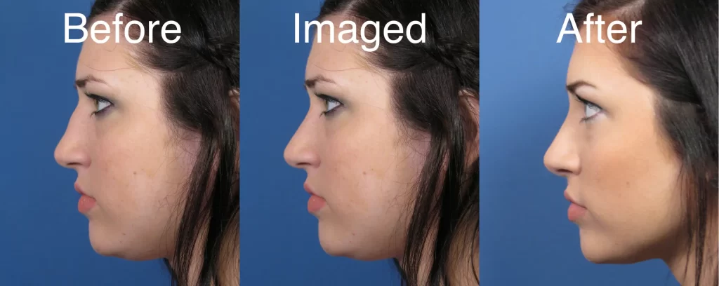 Side profile images showing a woman's face before, imaged, and after a cosmetic procedure, highlighting changes in her nose and chin alignment.