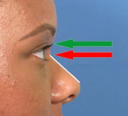 Profile view of a person’s face with arrows indicating measurements. A green arrow points to the upper eyelid, and a red arrow points to the lower eyelid against a blue background.