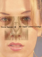 Image of a person's face overlaid with a transparent anatomical illustration of the nasal cavity, labeling the dorsal septum and upper lateral cartilage.