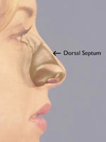 Profile illustration of a person's face with an arrow pointing to the dorsal septum on the nose.