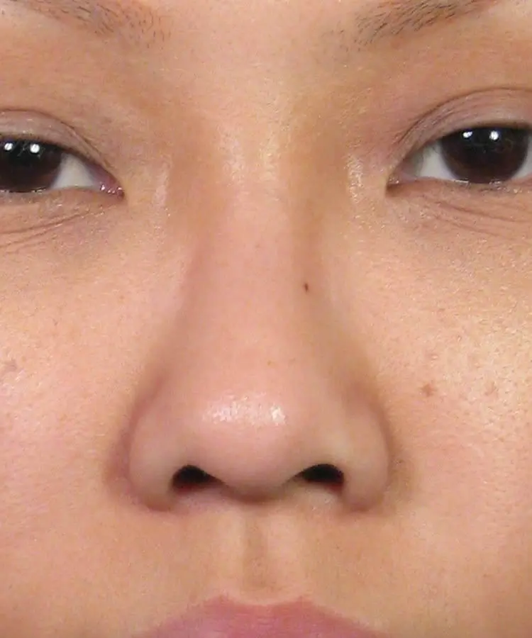 Front view of the face of a female Asian patient before revision rhinoplasty