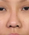 Asian female patient's nose rhinoplasty evaluation