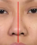 Close-up of Asian female patient's face showing a red vertical line down the middle of the nose.
