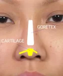 Close-up of an Asian revision rhinoplasty female patient's face showing a diagram overlay. Labels indicate "Goretex" for the bridge and "Cartilage" for the tip of the nose.
