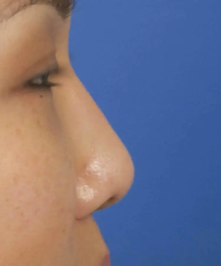 Lateral view of the face of a female Asian patient before rhinoplasty