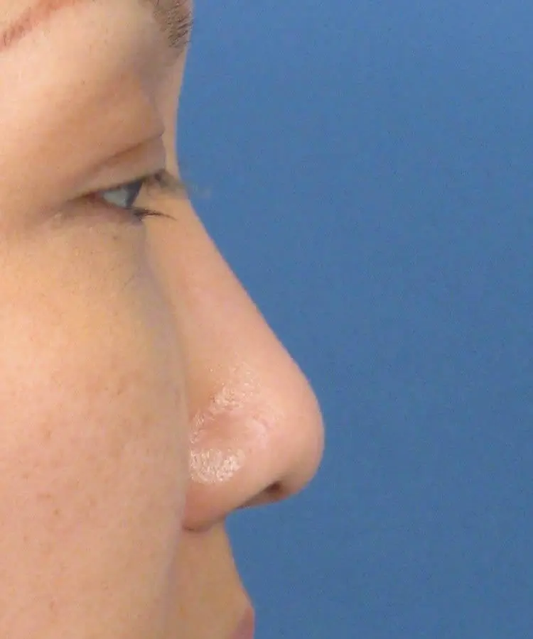 Lateral view of the face of a female Asian patient before rhinoplasty