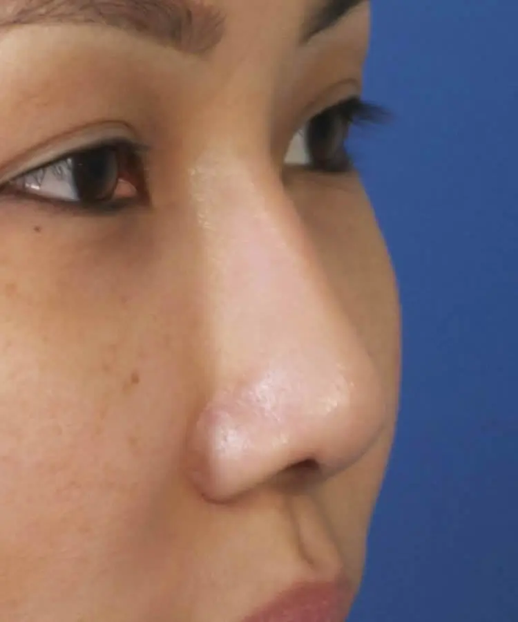 Oblique view of the face of a female Asian patient after rhinoplasty