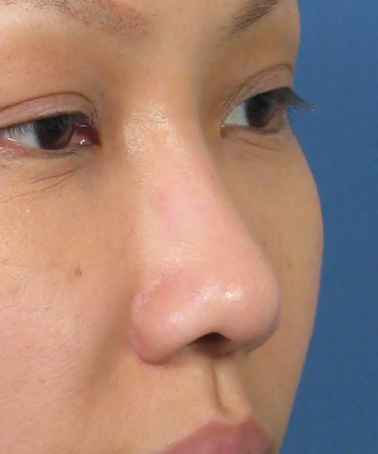Oblique view of the face of a female Asian patient before rhinoplasty