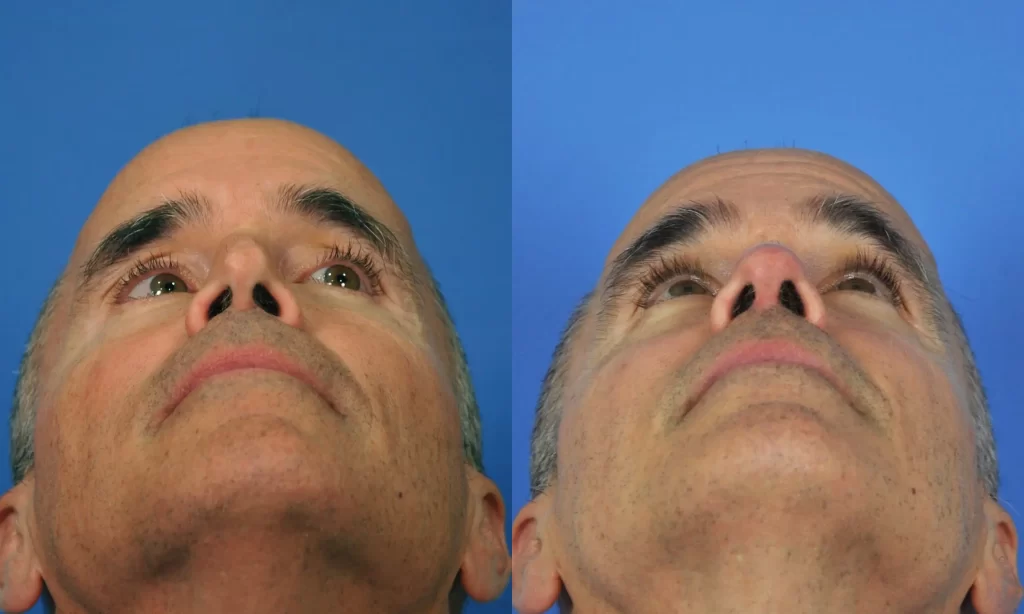Two side-by-side images showing a man's face from a low angle before and after a rhinoplasty, highlighting the change in nasal structure against a blue background.
