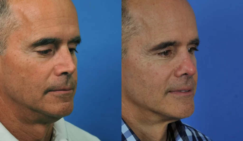 A split image of a bald man before and after a procedure, showing improved skin complexion and appearance.