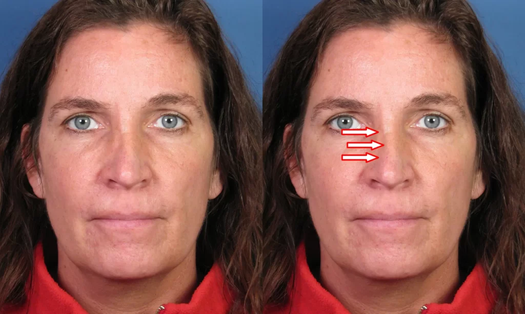 Before and after images of a woman's face, showing three red arrows pointing at her nose in the after image.