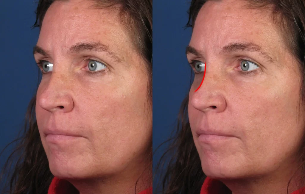 Side-by-side comparison of a woman's face before and after a cosmetic procedure, showing a reduction in nose size and smoother skin texture.