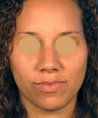 Front view of the face of a female African-American patient after rhinoplasty