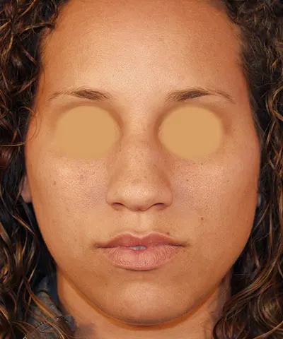 Front view of the face of a female African-American patient before rhinoplasty