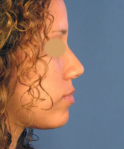 Lateral view of the face of a female African-American patient after rhinoplasty