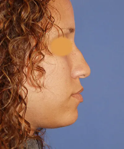 Lateral view of the face of a female African-American patient before rhinoplasty