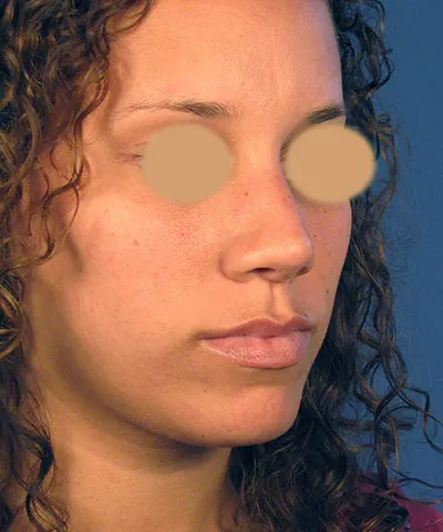 Oblique view of the face of a female African-American patient after rhinoplasty