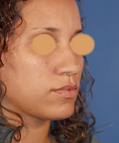 Oblique view of the face of a female African-American patient before rhinoplasty