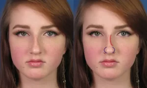 Side-by-side images of a person with freckles; the right image has marked lines indicating changes to the nose.