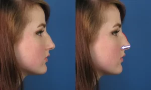 Side-by-side images of a woman's profile before and after a digital nose adjustment, with an arrow pointing to the nose in the after image.