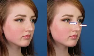 Comparison of a woman's face before and after image editing, focusing on nose reshaping.