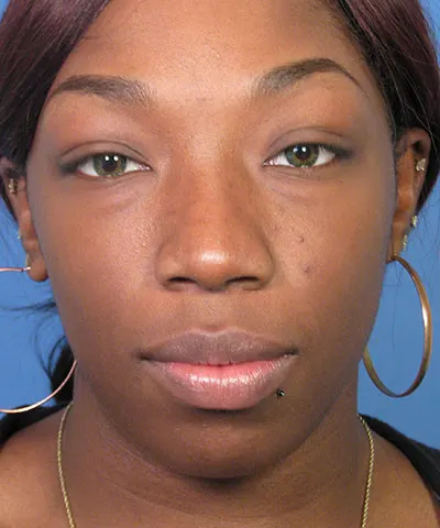 Front view of the face of a female African-American patient after rhinoplasty