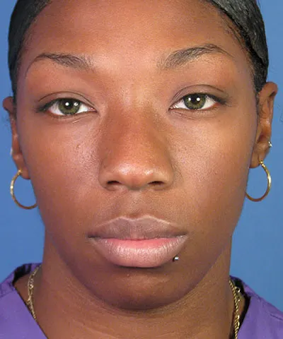 Front view of the face of a female African-American patient before rhinoplasty