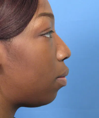 Lateral view of the face of a female African-American patient after rhinoplasty
