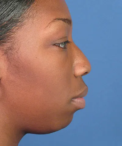 Lateral view of the face of a female African-American patient before rhinoplasty