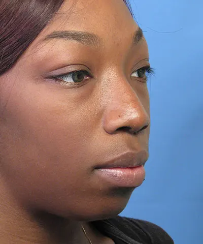 Oblique view of the face of a female African-American patient after rhinoplasty