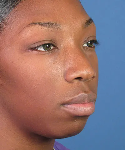Oblique view of the face of a female African-American patient before rhinoplasty
