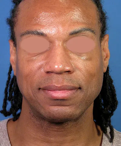 Front view of the face of a male African-American patient after the rhinoplasty