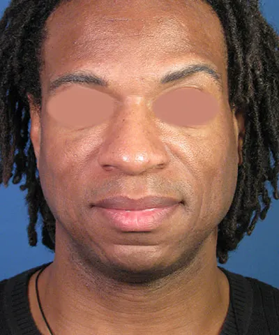 Front view of the face of a male African-American patient before the rhinoplasty