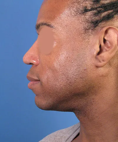 Lateral view of the face of a male African-American patient after the rhinoplasty