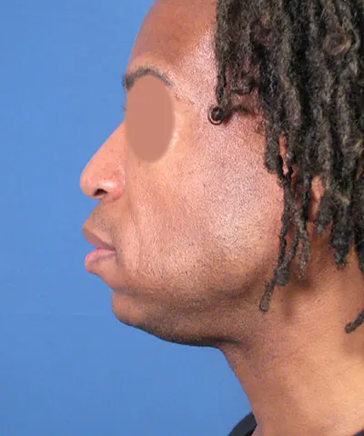 Lateral view of the face of a male African-American patient before the rhinoplasty