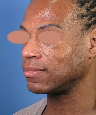 Oblique view of the face of a male African-American patient after the rhinoplasty