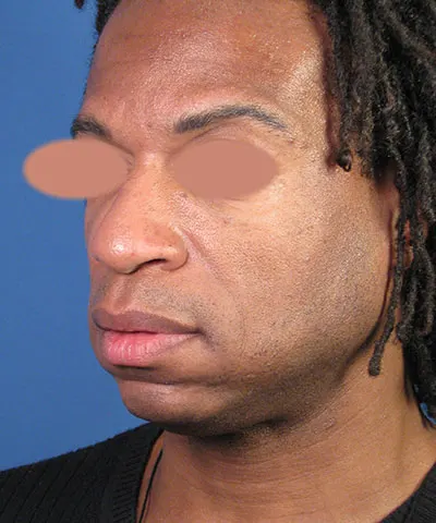 Oblique view of the face of a male African-American patient before the rhinoplasty
