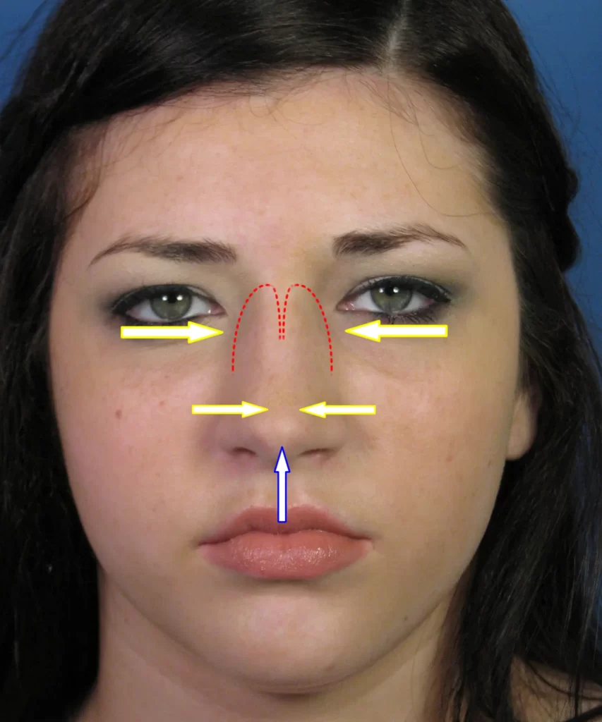 Facial analysis diagram on a woman's face, with arrows and lines illustrating features and measurements.