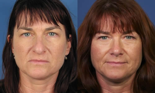 Side-by-side comparison of a woman's face before and after a cosmetic procedure, showing changes in skin tone and texture.