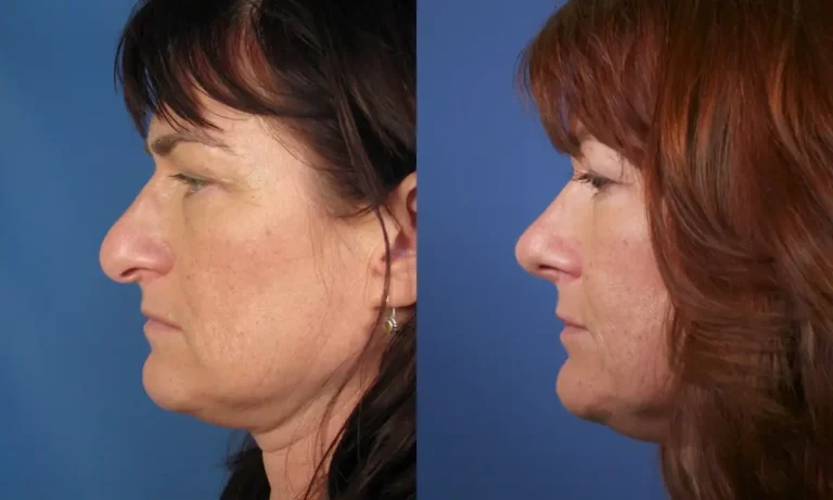 Side-by-side profile views of the same woman before and after undergoing a cosmetic nose surgery, showing a noticeable change in the shape of her nose.