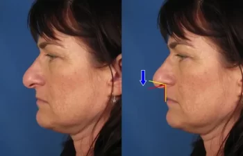 Side-by-side profile images of a woman showing before and after a rhinoplasty procedure; the after image includes colored lines and arrows indicating changes in the nose's shape.