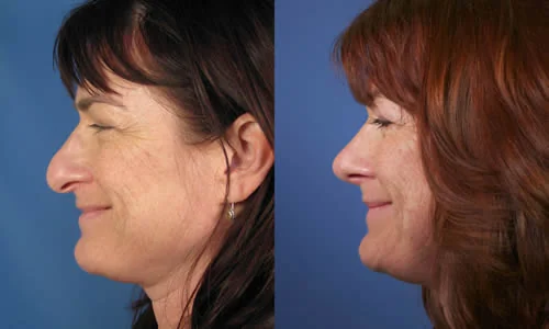 Side-by-side profile view of a woman before and after rhinoplasty, showing changes to her nose and chin.