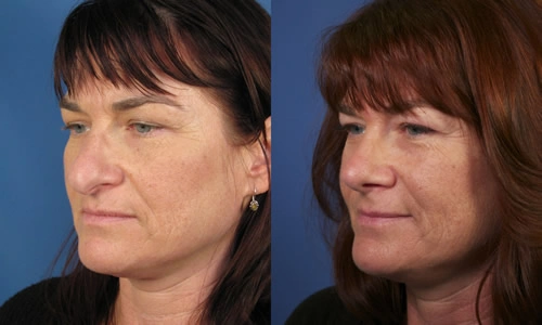 Before and after comparison of a woman's face, showing differences in skin texture and tone against a blue background.
