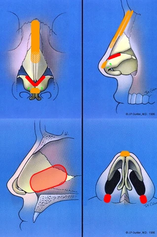 Medical illustration showing nasal anatomy from different angles, highlighting structures such as the septum and nasal passages with colored sections.