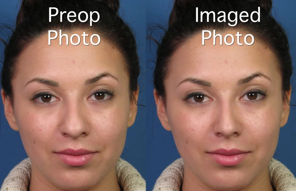 Side-by-side comparison of a woman's face, labeled "Preop Photo" on the left and "Imaged Photo" on the right, showing subtle differences in facial features.