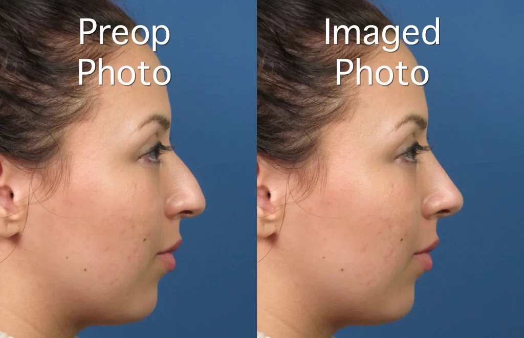 Side-by-side profile photos of a woman before and after a procedure. Left: pre-op photo. Right: post-op photo with slight changes to nose shape.