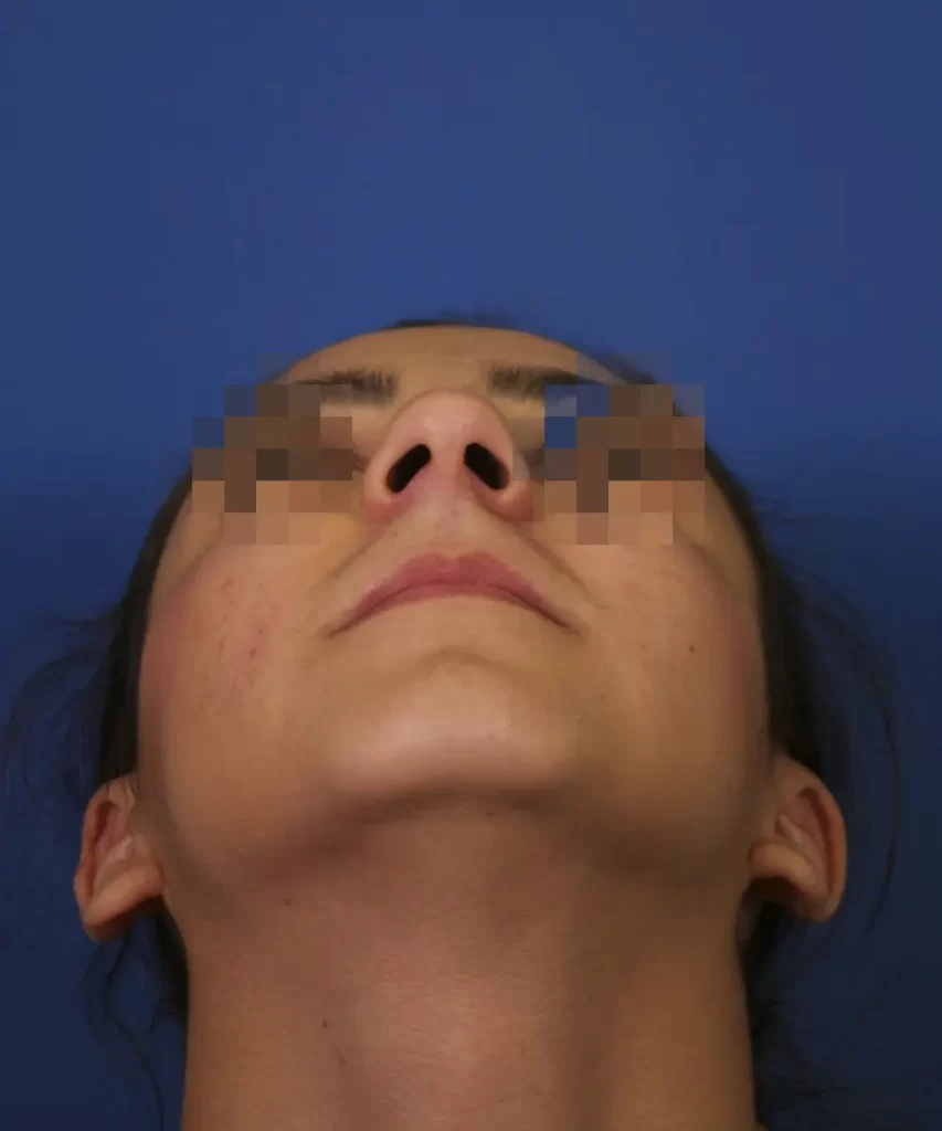 Close-up of a person's face looking upward with eyes pixelated, showing nostrils and chin against a blue background.