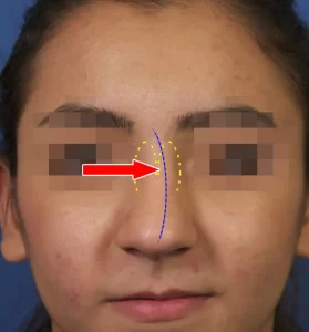 A face with pixelated eyes; a red arrow points to the nose, highlighted with dashed lines.
